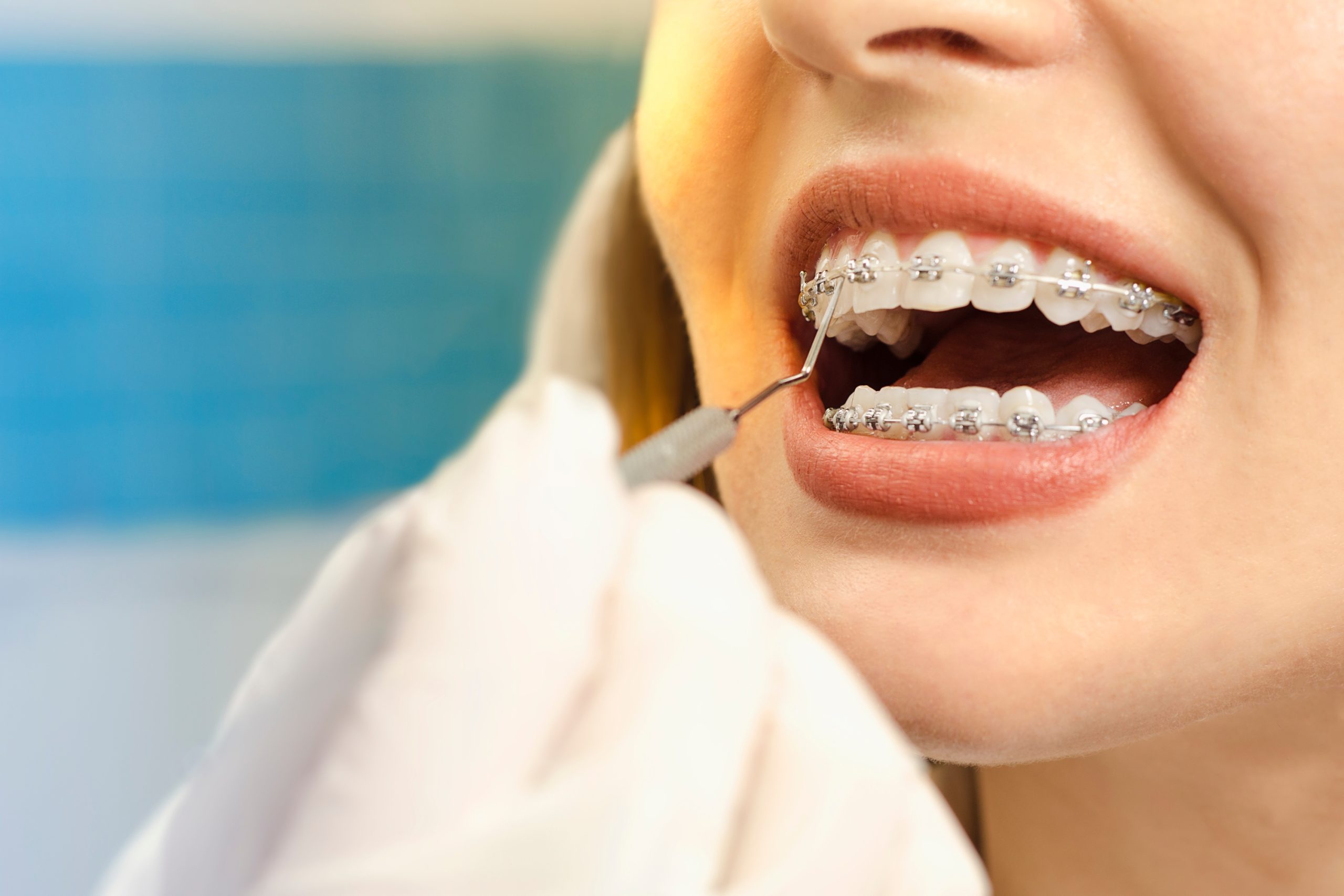 braces